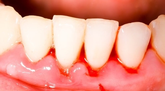 Causas de las encías sangrantes - Clínica Dental en Valencia Benimaclet ARTDENTA