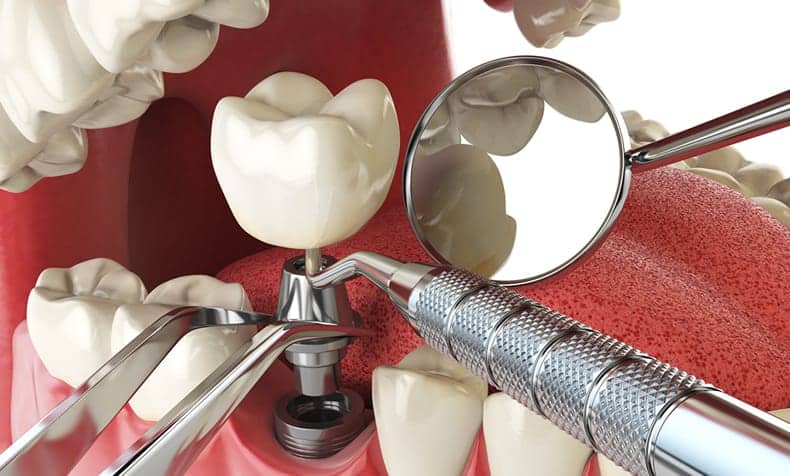 Implantes Dentales - Clínica Dental en Valencia Benimaclet