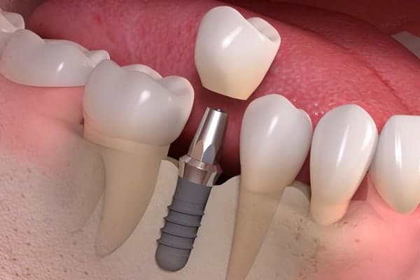 Cuidados Implante dental - Clínica Dental en Valencia Benimaclet