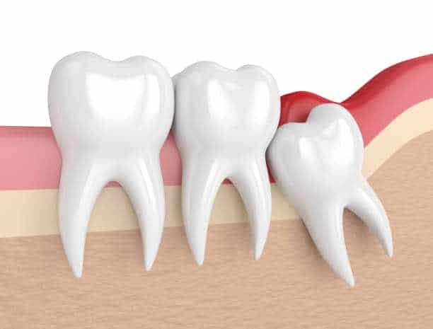 Dientes Apiñados - Clínica Dental Artdenta