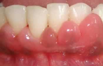 Encías hinchadas en encáis sangrantes | Clínica dental en Valencia | Artdenta