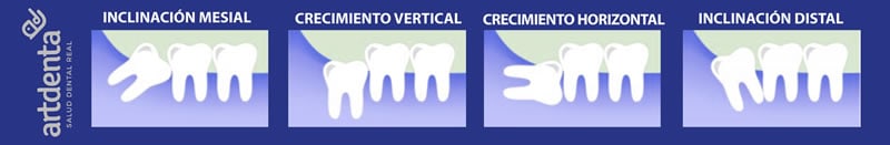 Tipos de anomalías en Muelas del Juicio | Clínica Dental en Valencia Artdenta