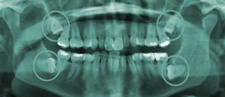 Radiografía Muelas del Juicio | Clínica Dental en Valencia ARTDENTA