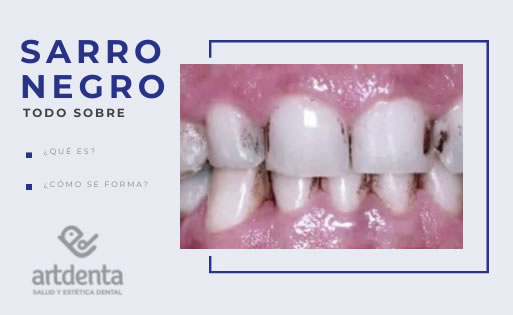 Sarro Negro | Clínica Dental Artdenta