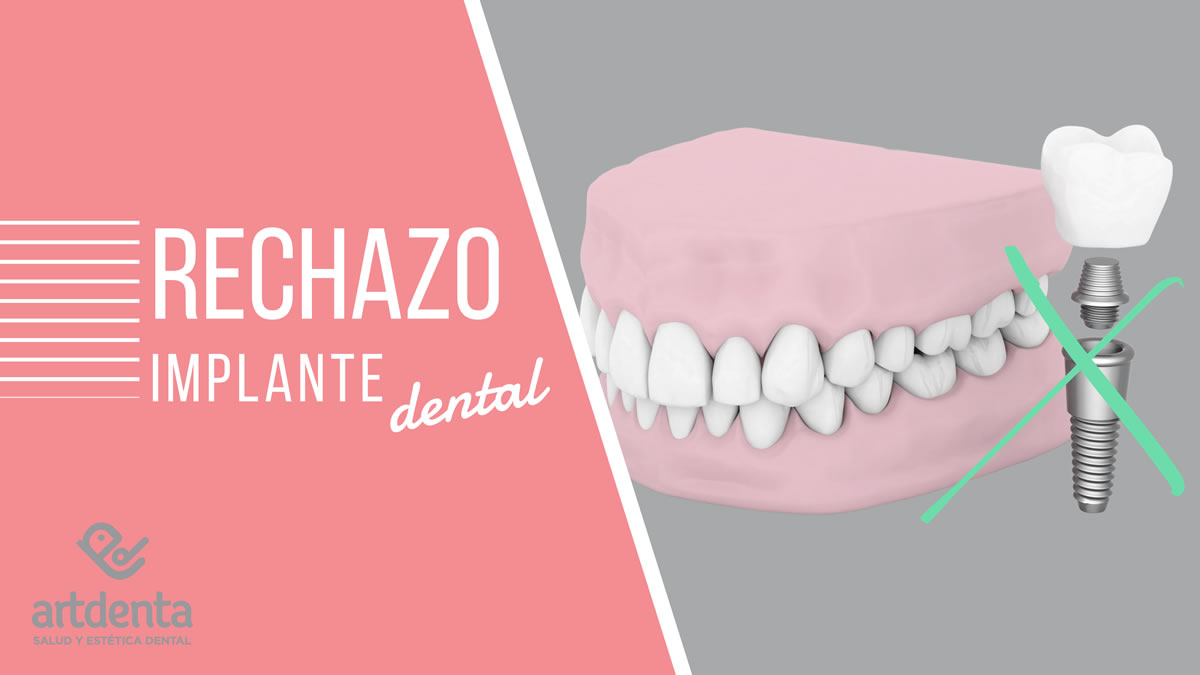 Banner Rechazo Implante Dental | Clínica Dental Artdenta Valencia