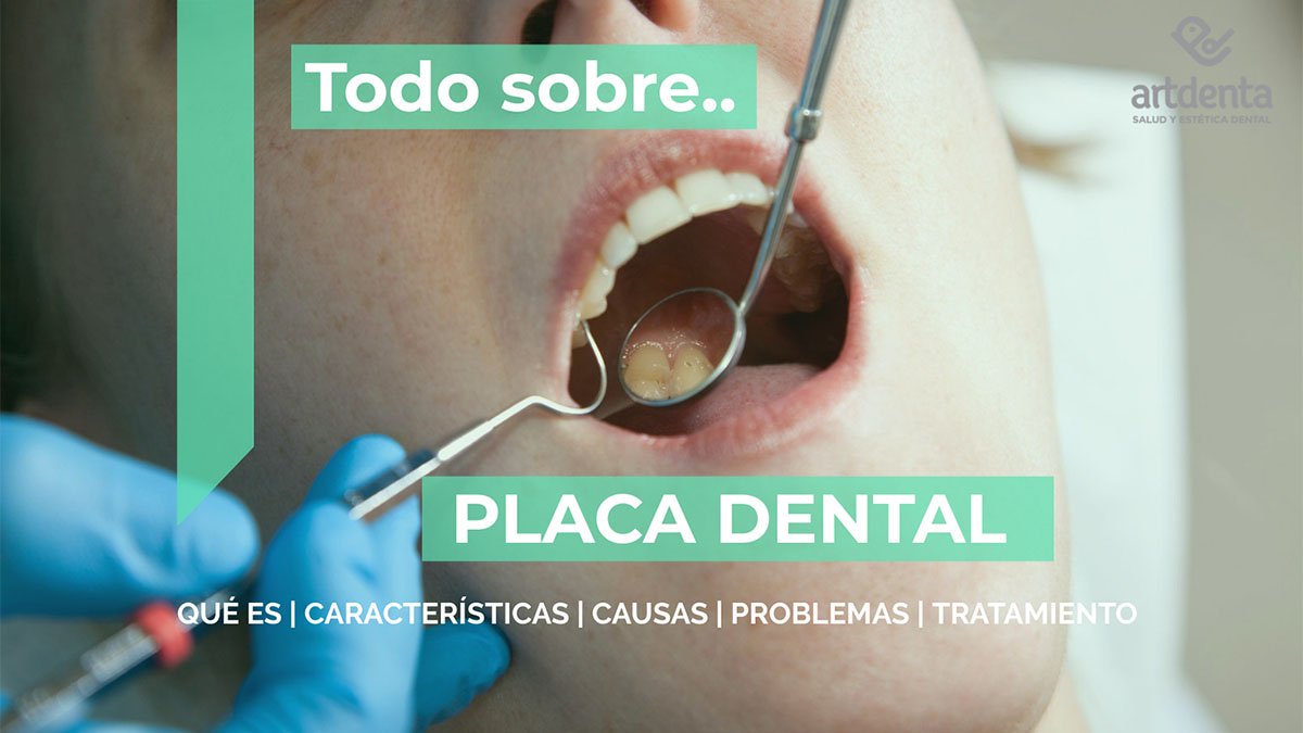 Banner Placa Dental | Clínica Dental Artdenta Valencia