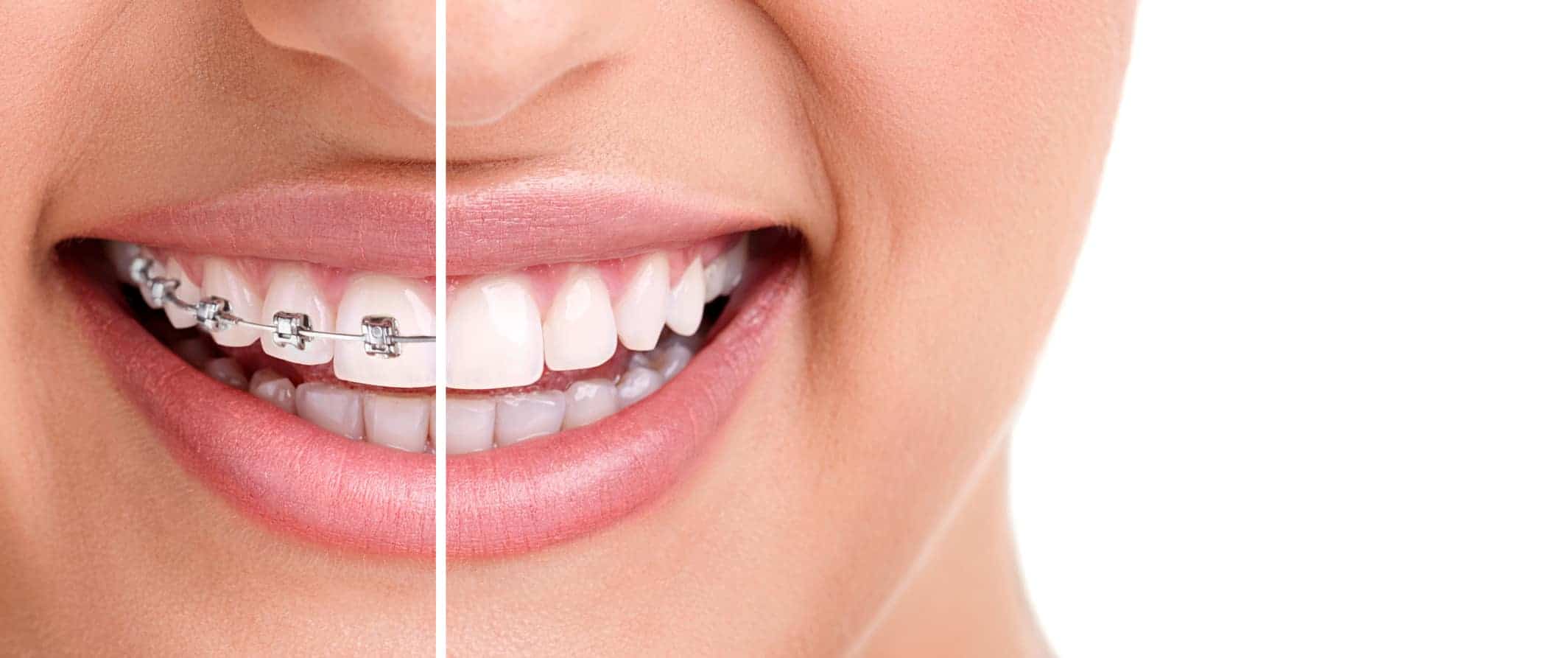 Tipos de ortodoncia - Clínica Dental en Valencia Benimaclet ARTDENTA