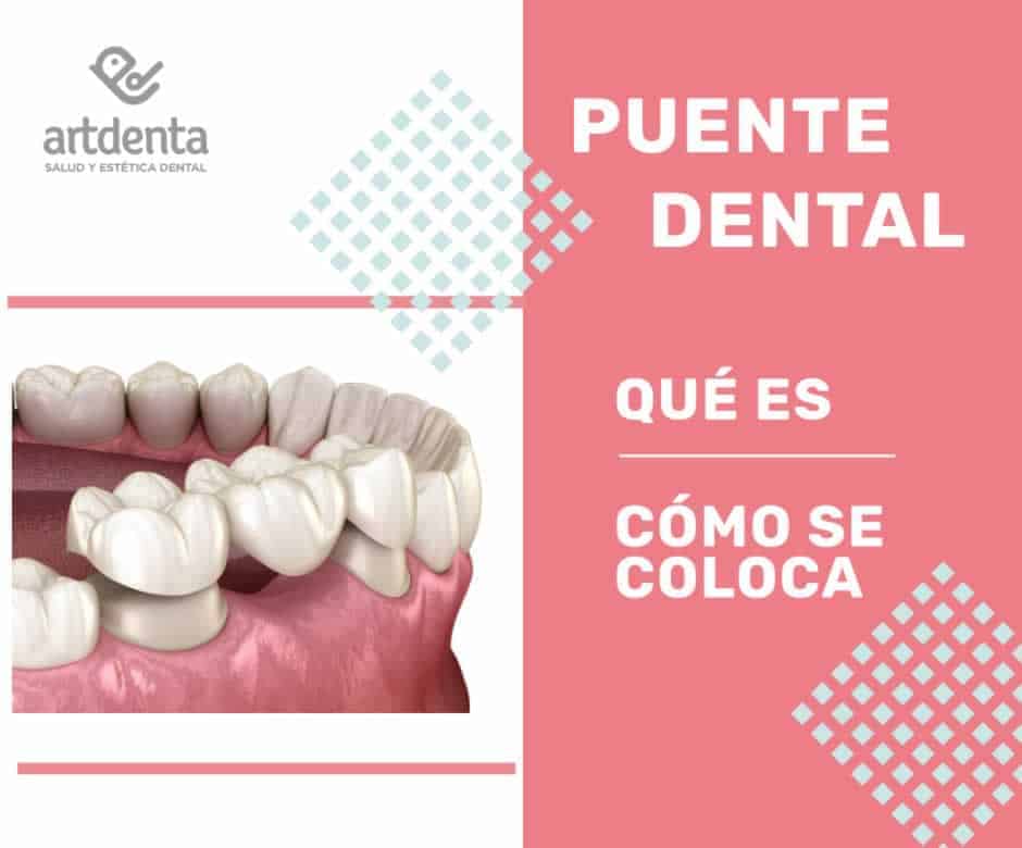 Qué es un Puente dental | Clínica dental Artdenta VALENCIA