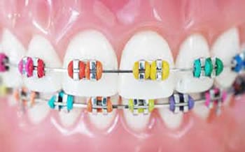 Brackets metálicos de colores | Clínica Dental Artdenta Valencia