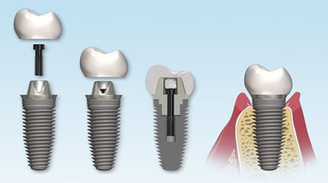 Partes de Implante Dental | Clínica Dental Artdenta Valencia