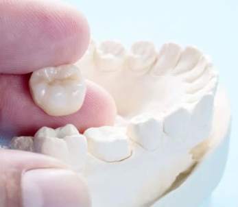 Molde de Corona Dental | Clínica Dental Artdenta Valencia