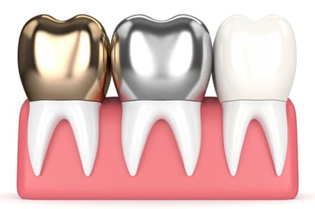 Materiales Corona Dental | Clínica Dental Artdenta Valencia