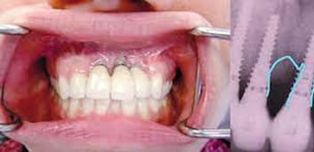 Periimplantitis | Dental Artdenta Valencia