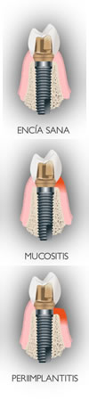 Mucositis Perrimplantitis | Dental Artdenta Valencia