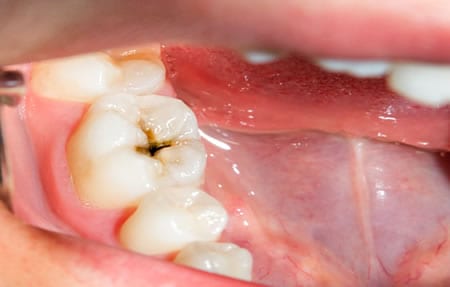 Odontopediatría Caries infantil | Clínica Dental Artdenta Valencia